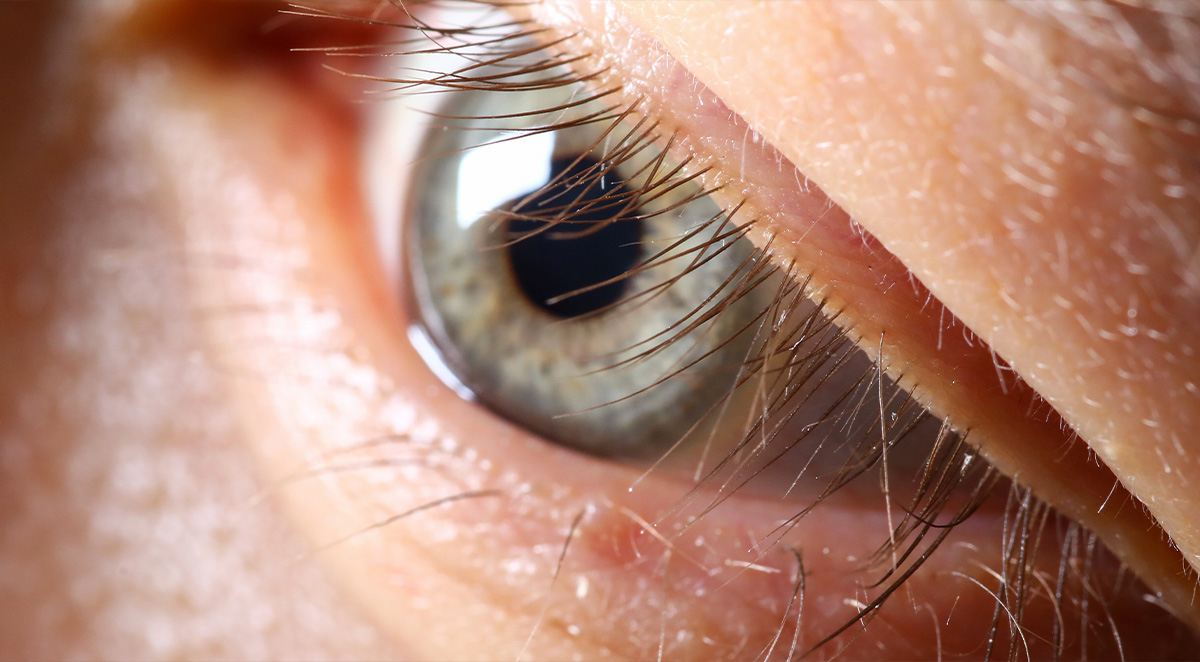 Four Glaucoma Myths